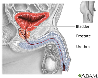 benign prostatic hyperplasia ncbi