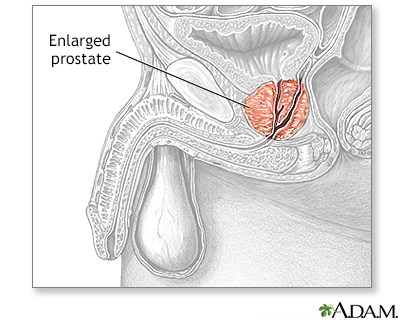 Prostate Stimulated