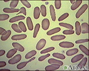 Red blood cells - elliptocytosis