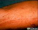 Poison oak rash on the arm