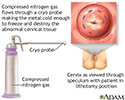 Cervical cryosurgery