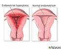 Abnormal menstrual periods