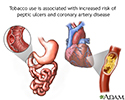 Tobacco and vascular disease
