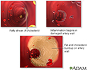 Arterial plaque build-up