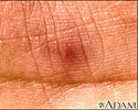 Janeway lesion - close-up