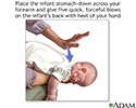 Heimlich maneuver on infant