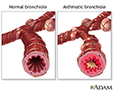 Normal versus asthmatic bronchiole