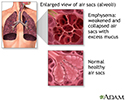 COPD (chronic obstructive pulmonary disorder)