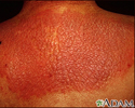 Lichen simplex chronicus on the back