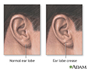 Ear lobe crease