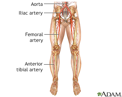 Peripheral Angioplasty
