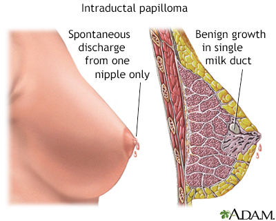 Intraductal papilloma young. Breast intraductal papilloma