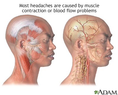 cluster headaches diagram