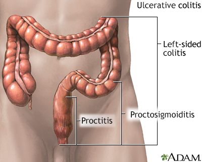 proctitis és prosztatitis