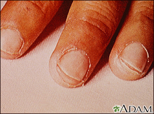 Kawasaki's disease, peeling of the fingertips