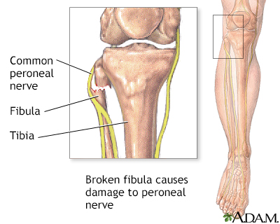 Hie Multimedia Common Peroneal Nerve Dysfunction