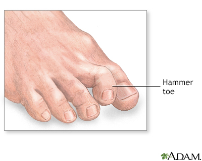mens shoes for severe hammertoe