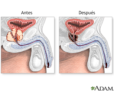 cum este operația de îndepărtare a adenomului de prostată prostata frauen