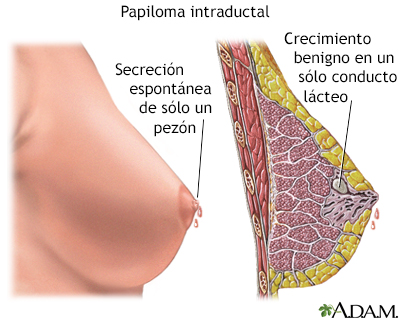 papiloma intraductal de mama sintomas provoacă condiloame vulvare