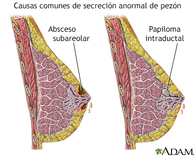 que son los papilomas intraductales