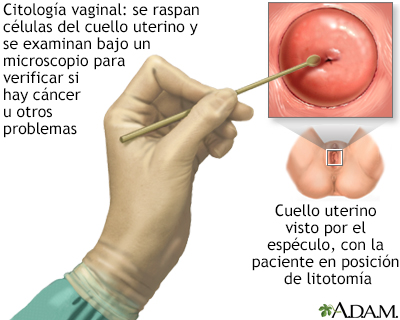 papanicolaou anormal y vph negativo