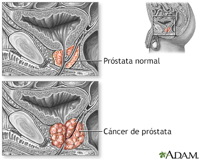cáncer de próstata grado 2 pronóstico
