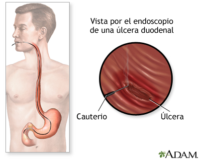 Ulcerul gastric si duodenal - Farmacia Ta - Farmacia Ta - Ulcer stomacal și dureri articulare