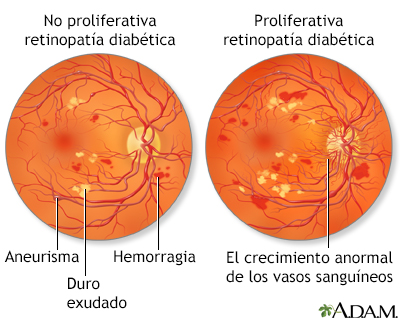 retinopatia diabetica proliferativa