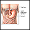 Gastroesophageal reflux - series